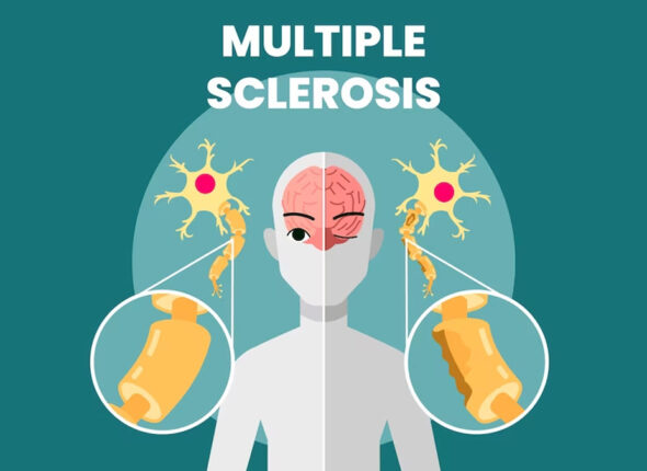 Multiple-sclerosis-MD